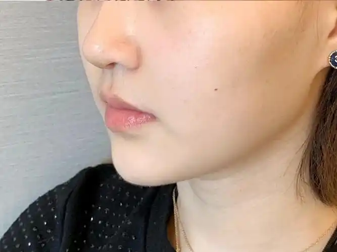 诊断:求美者鼻翼基底凹陷,视觉上侧面显面中凹陷,法令纹深.