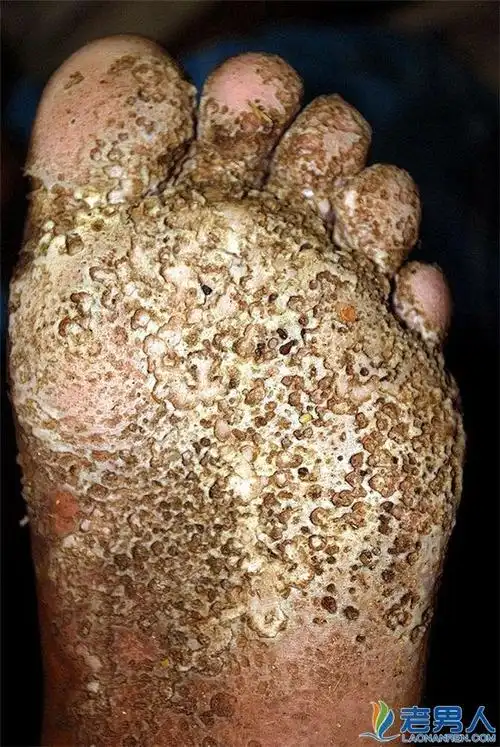 密集恐惧症如何克服及密集恐惧症图片(胆小慎入) / 比乐族