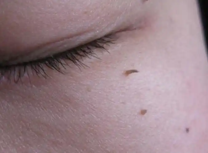 脖子上长小肉粒别忽视,可能是hpv感染!