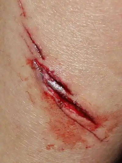 今天自己把纱布拆了下来打算晾晾伤口,发现还是在流血,但是
