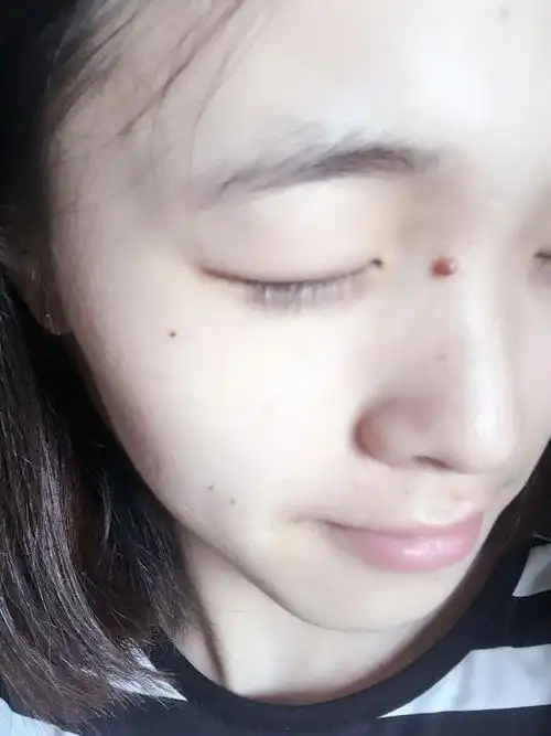 各位朋友,我这个肉痣能去掉吗?