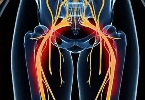 坐骨神经痛究竟是怎么回事?专家来回答!