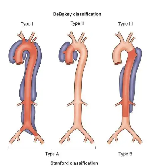 主动脉夹层是什么