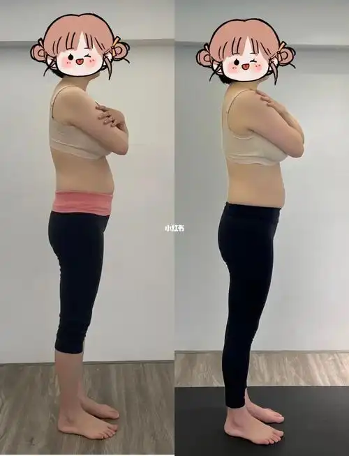 圆肩驼背改善对比图90