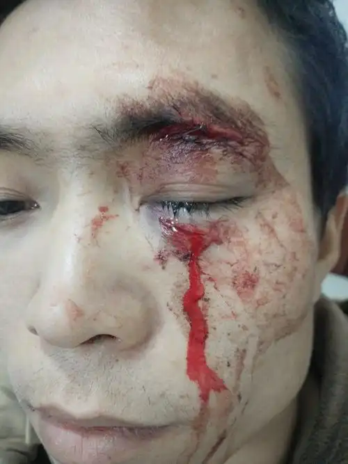 各种眼睑裂伤术前,术后对比.