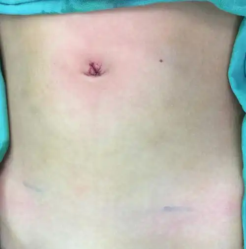 单部位腹腔镜治疗小儿腹股沟斜疝-术后无痕 - 好大夫在线