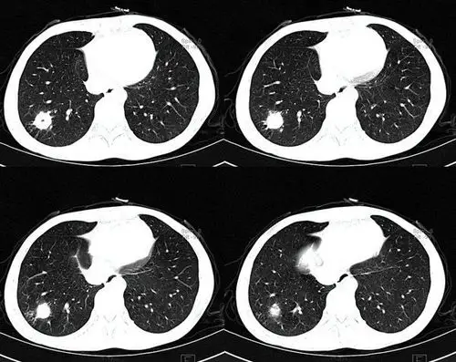 内壁和外壁均为圆形的空洞型结核球——潘军平老师