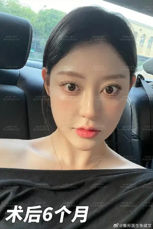 半肋鼻综合术后6个月反馈该患者目前鼻背微起伏,鼻尖自然圆润,鼻型