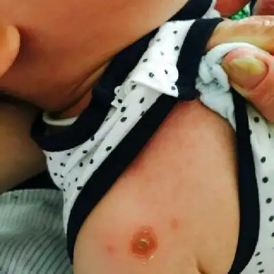 宝宝得了脓疱疮怎麼办