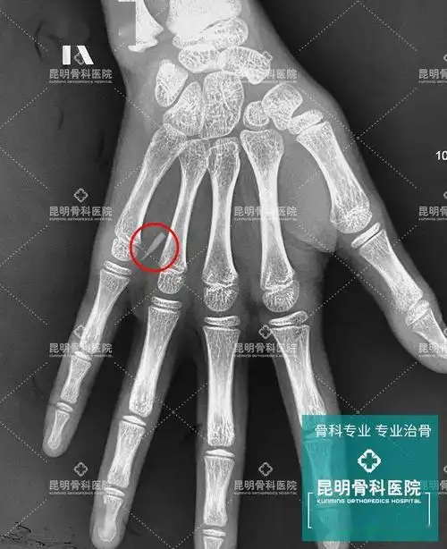 9岁女孩手掌刺痛,x光下拍到惊人一幕