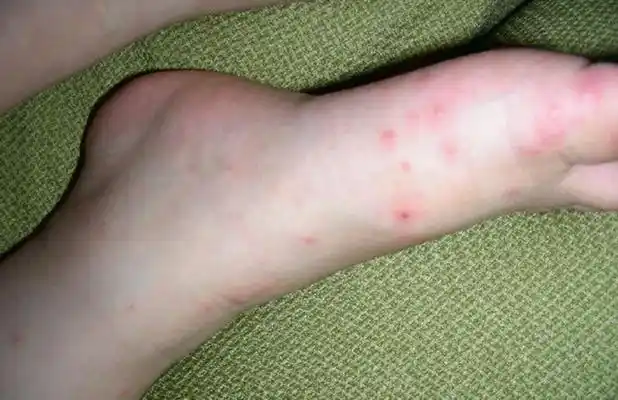 手足口病初期症状图片及治疗法 (58)