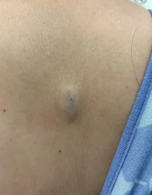 这是一位患者后背的所谓粉瘤,医学_圈子-新氧美容整形