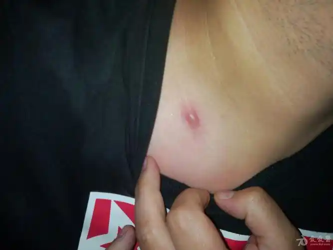 看图识病右侧锁骨下一红色包块压痛