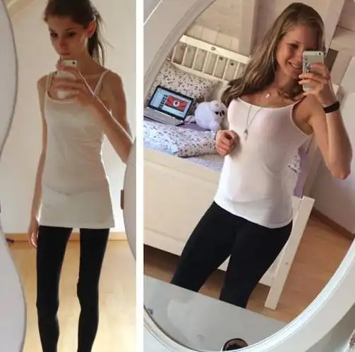 这是世界最瘦的女孩,最瘦时体重只有22公斤!(5)