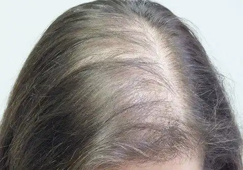 什么是脂溢性脱发(附图片)