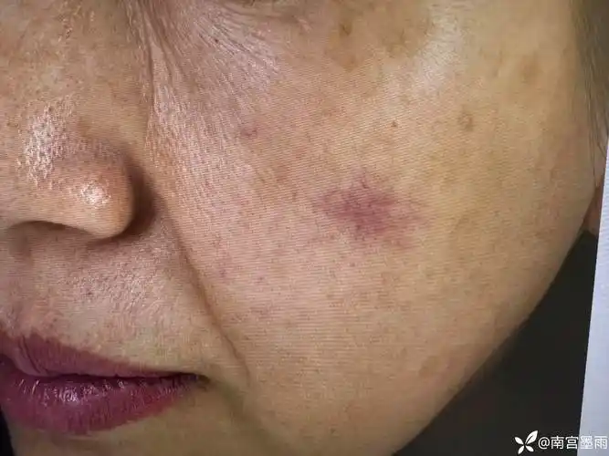 排除肝脏疾病的蜘蛛痣的损容治疗