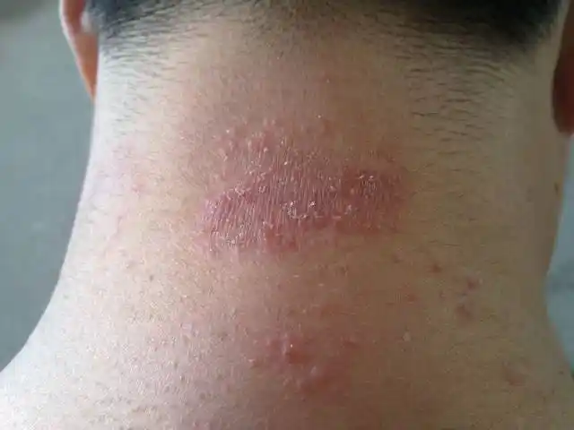 脖子上起了一片红疙瘩很痒是什么病