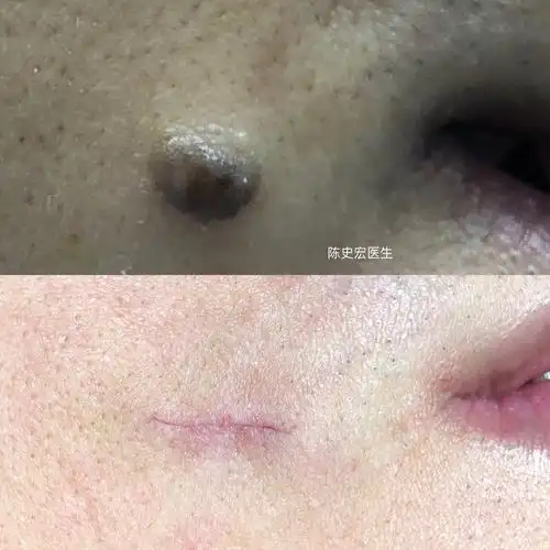 色素痣切除手术后即刻该图片可能引起不适继续查看色素痣切除手术后