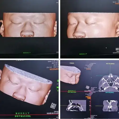 我院耳鼻喉科成功为患者进行鼻骨骨折复位术