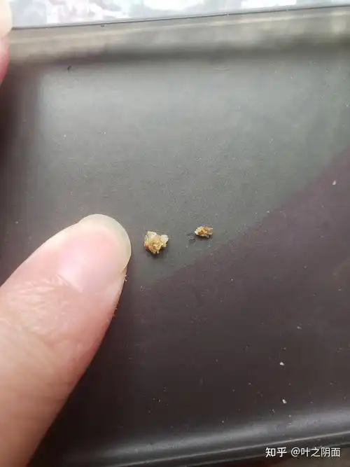 尿结石排出经历