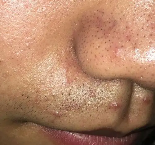 黑头这么多?那么恶心的 草莓鼻怎么办?-搜狐