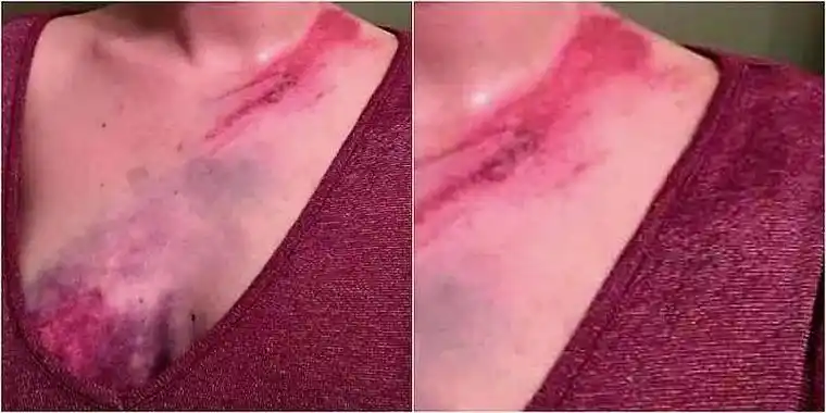 为什么胸部越大,发生交通事故时越容易受伤?