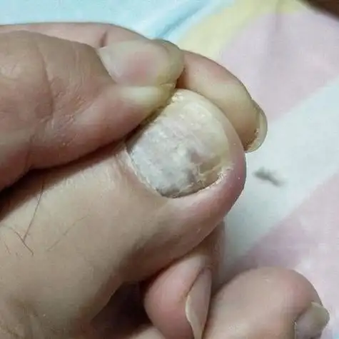 灰指甲要刮多薄指甲才能涂药-红霉素软膏灰指甲最有效吗 - 鞍知识