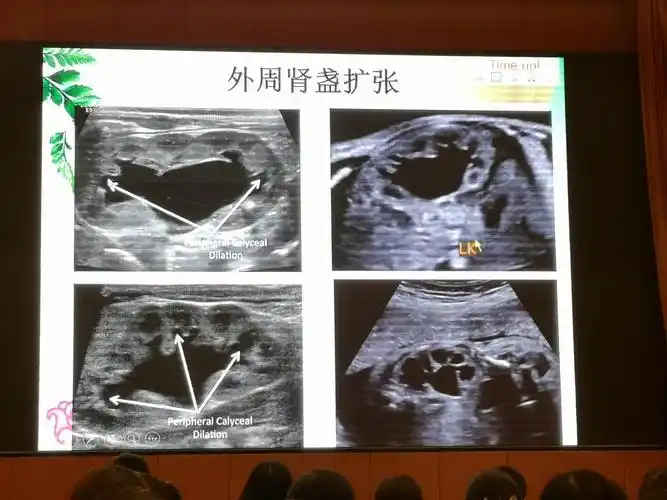 胎儿肾盂分离—如何描述和提示