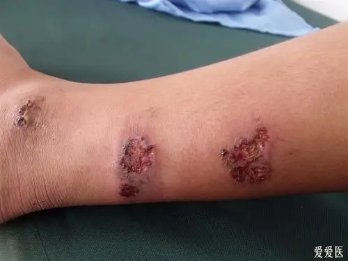 胞子丝菌病治疗四天的变化 - 皮肤及性传播疾病讨论版 - 爱爱医医学