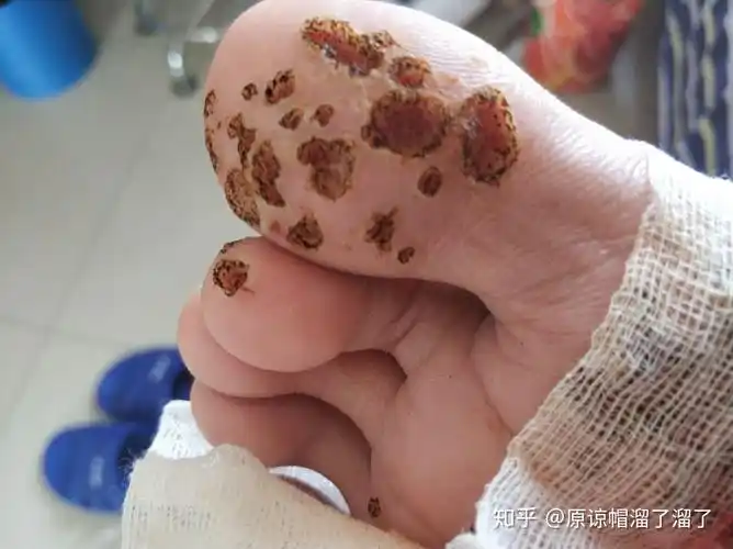 治疗跖疣的长路