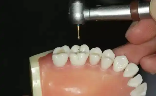 手把手教硅橡胶导板——牙体预备步骤详解2016-10-04