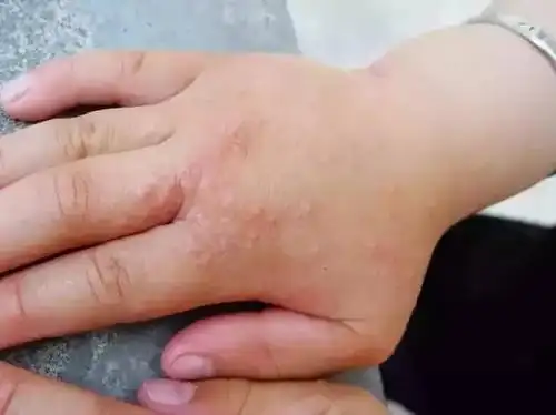 (汗疱疹示图)手癣:由于孩子皮肤较为娇嫩脆弱,如果家里人有感染手足癣