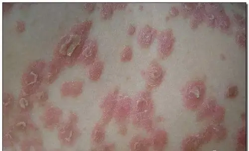 屠呦呦再次震惊全世界,治疗"红斑狼疮",取得了突破性的成果!_腾讯新闻