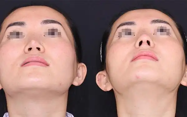 太原做硅胶垫山根医疗整形医院排名,都是知医生院,看看都是谁?