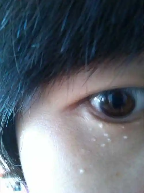 眼部为什么长脂肪粒怎么办 眼部为什么长脂肪粒怎么办才能消除