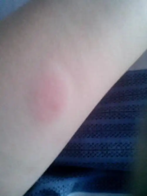 而且是阴性的,可是昨天我们学校做了ppd,结果是这样的