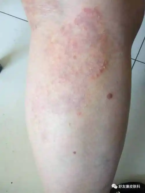 小腿上的真菌感染