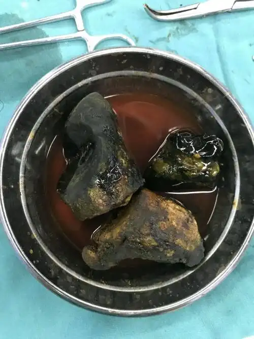 巨大胆管结石,长18cm,粗8cm,很罕见 - 好大夫在线