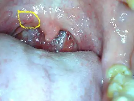 腭垂傍边的咽峡处有个红嘎达