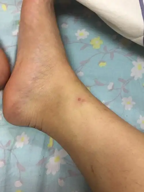 应该怎么办啊? 好痒