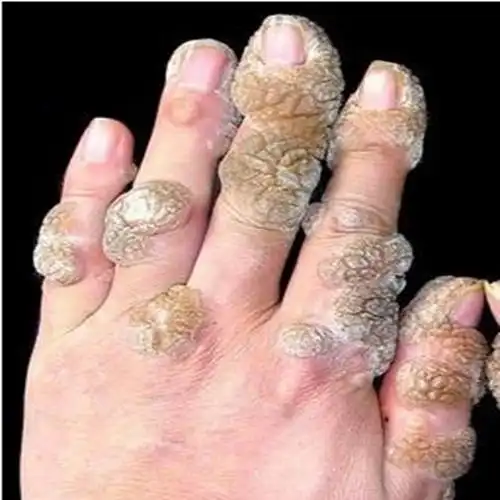 麻风病导致手指变形的图片