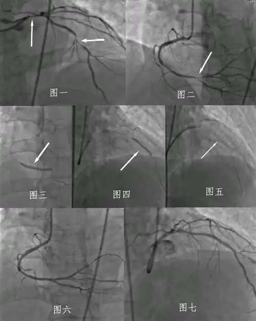 正常冠脉造影和冠状动脉支架植入术图解