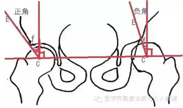 ce角:也称中心边缘角(如上图):指双侧股骨头中心点的连线的垂线与与