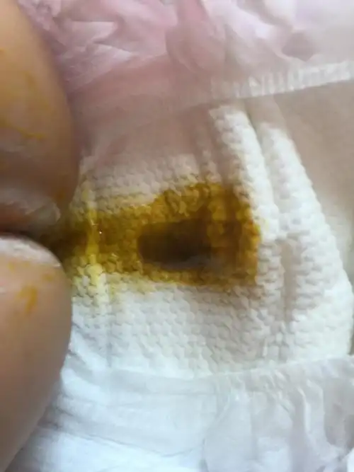 宝宝两个月二十五天拉肚子,黄绿色带泡沫,屁多而且每次放屁就带出大便