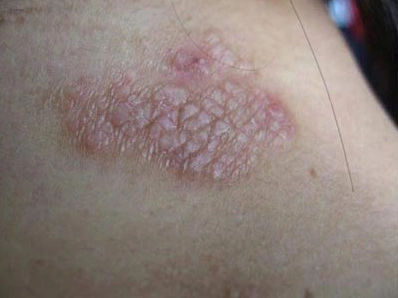 宣化卫十肤之神经性皮炎解析