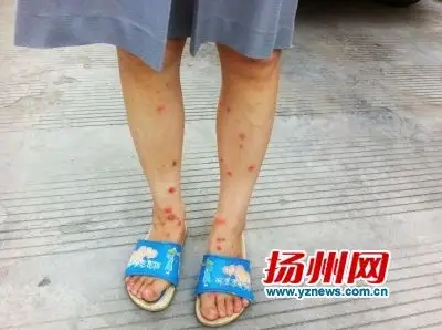 他们的家里总是莫名其妙地出现虱子,腿上被咬了成片的包,又红又肿