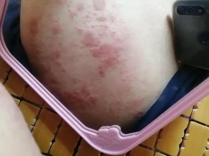 大腿根部皮肤发红瘙痒