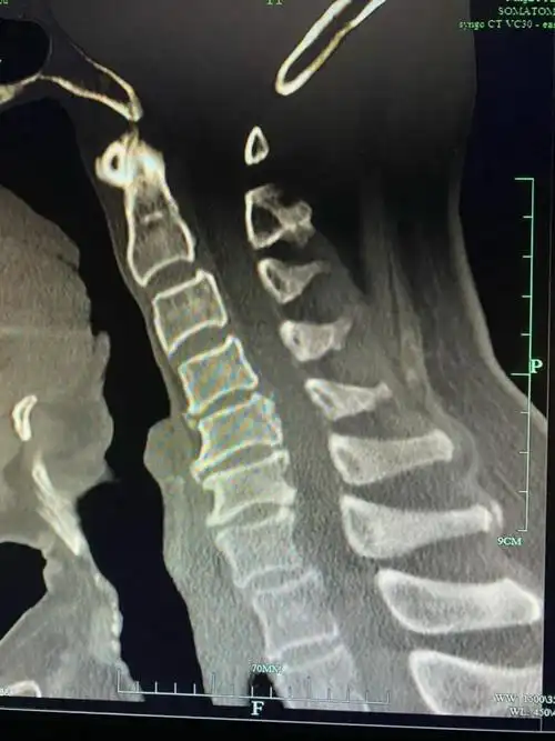 颈椎ct示:颈4-5骨赘增生严重颈椎侧位片示:颈椎生理曲度消失,反弓术中