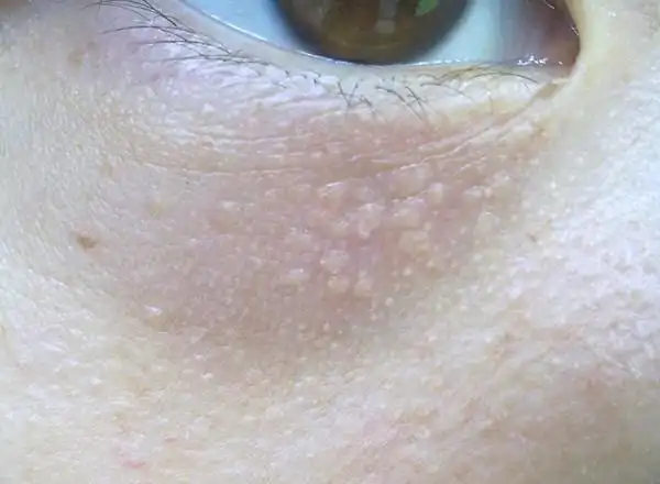 脂肪粒的解决办法