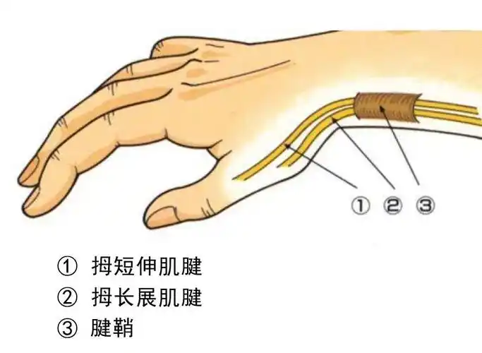 很大程度是拇短伸肌和拇长展肌腱鞘的慢性炎症引起.